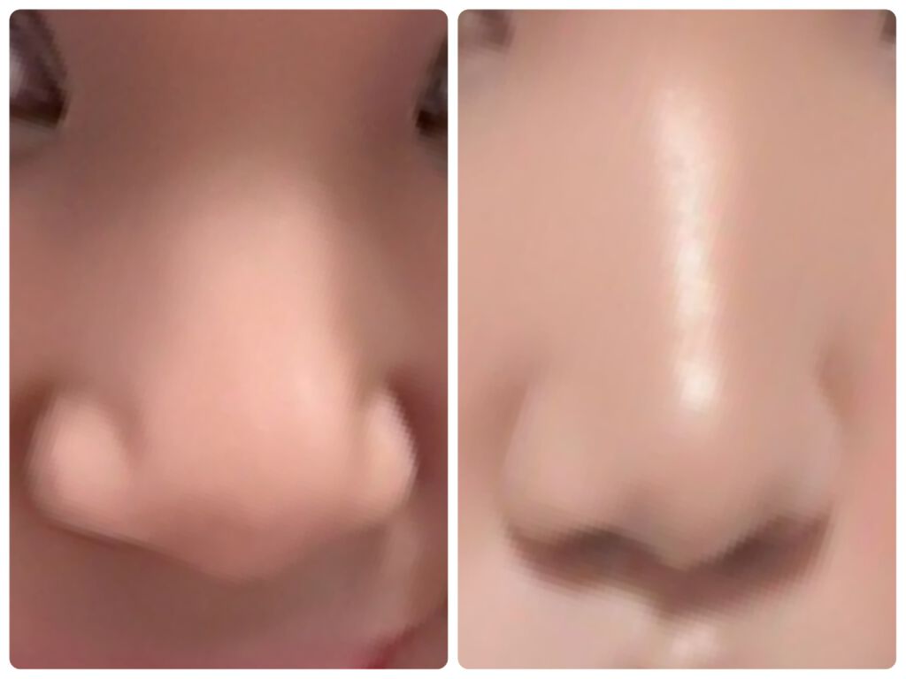 鼻尖形成(団子鼻修正)/日本クリニック/その他を使ったクチコミ（2枚目）
