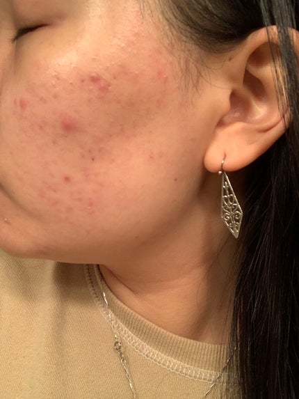 ティーツリーケア ソリューション エッセンシャルマスクEX/MEDIHEAL/シートマスク・パックを使ったクチコミ(3枚目)