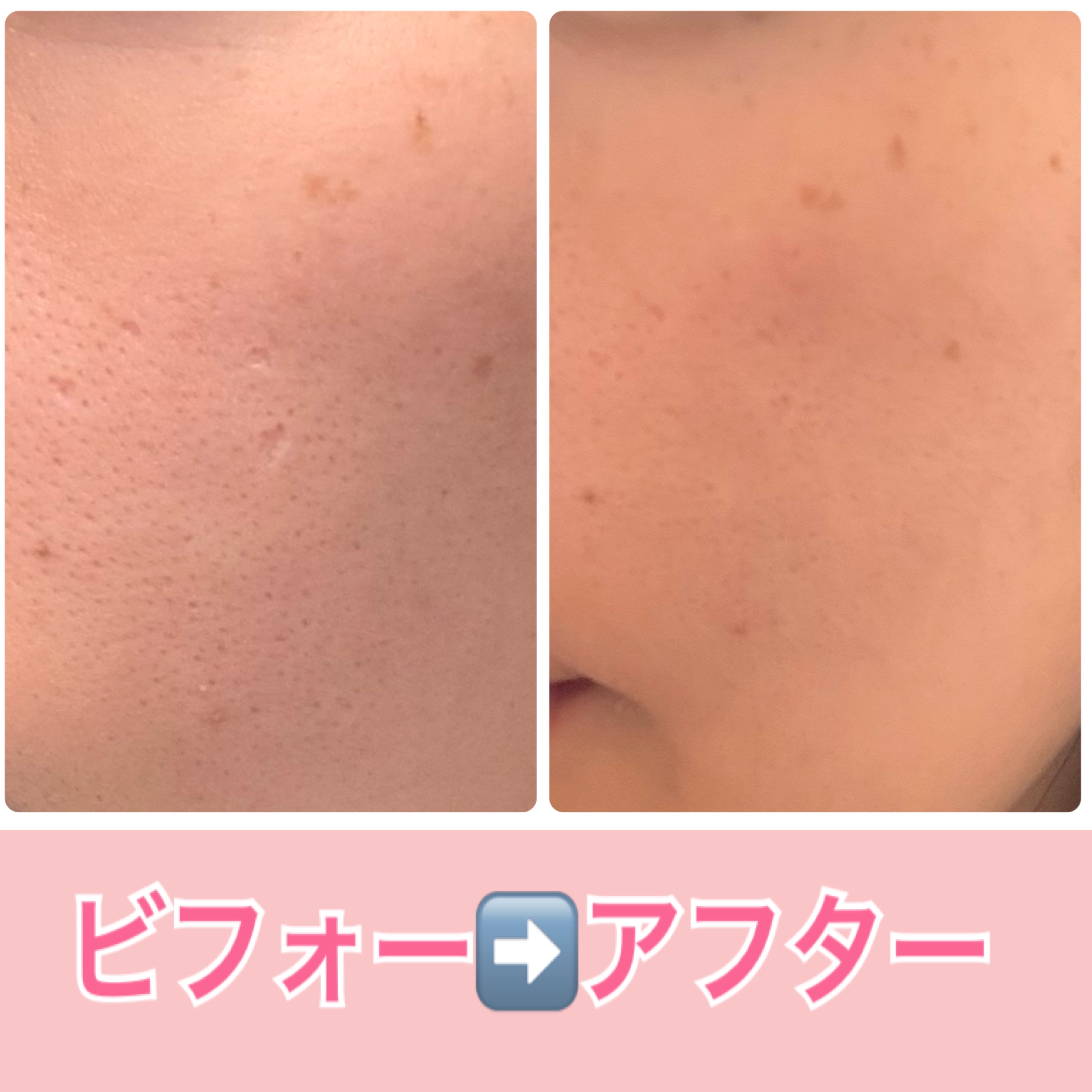 センテラ クイックカーミングパッド/SKIN1004/トナーパッドを使ったクチコミ（3枚目）