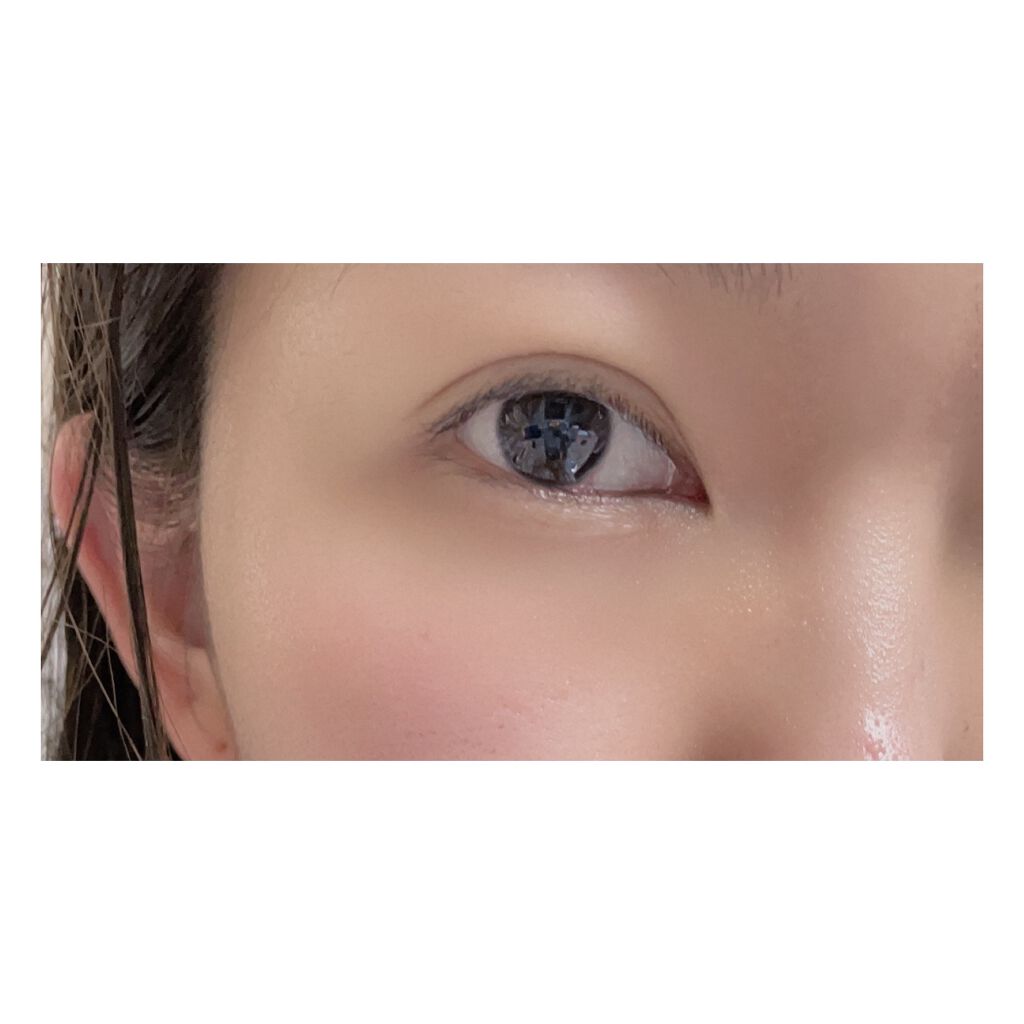 るー on LIPS 「【二重整形について】ついについに…!今日やっと念願であった二重..」(2枚目)