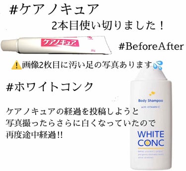 ケアノキュア（医薬品）/小林製薬/その他を使ったクチコミ（1枚目）