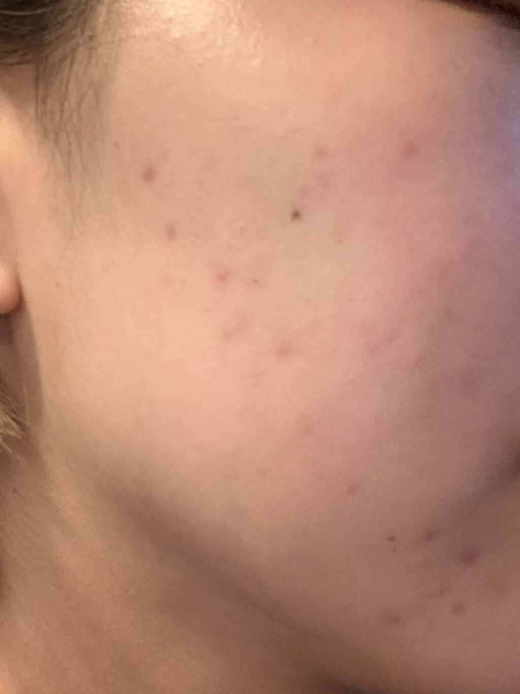 ピアソンＨＰクリーム(医薬品)/ピアソンHP/その他を使ったクチコミ（1枚目）