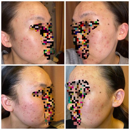 イベリコ豚 on LIPS 「ニキビになり早12年が経過しています。良くなるどころか悪くなる..」(4枚目)