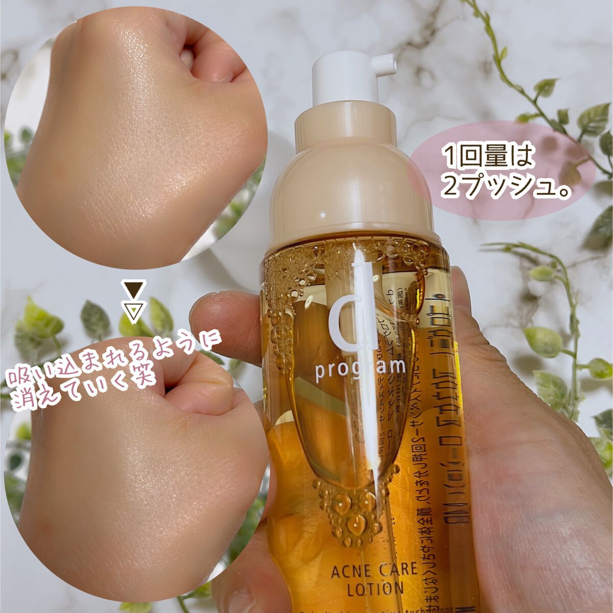 アクネケア ローション MB/d プログラム/化粧水を使ったクチコミ(5枚目)