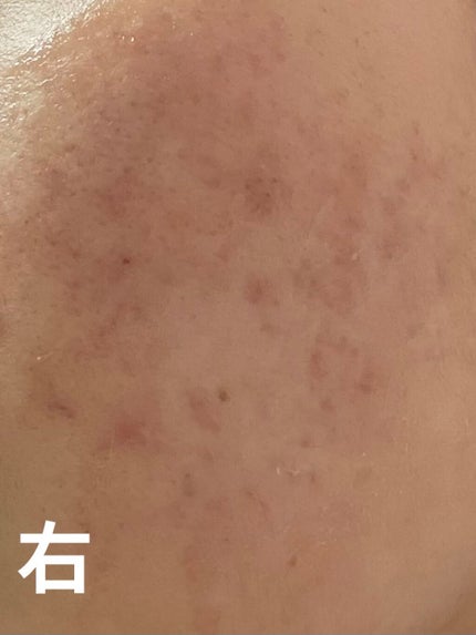 キツネ on LIPS 「今まで右側そんなに肌荒れしてなかったけど、べピオ塗り始めてから..」(2枚目)