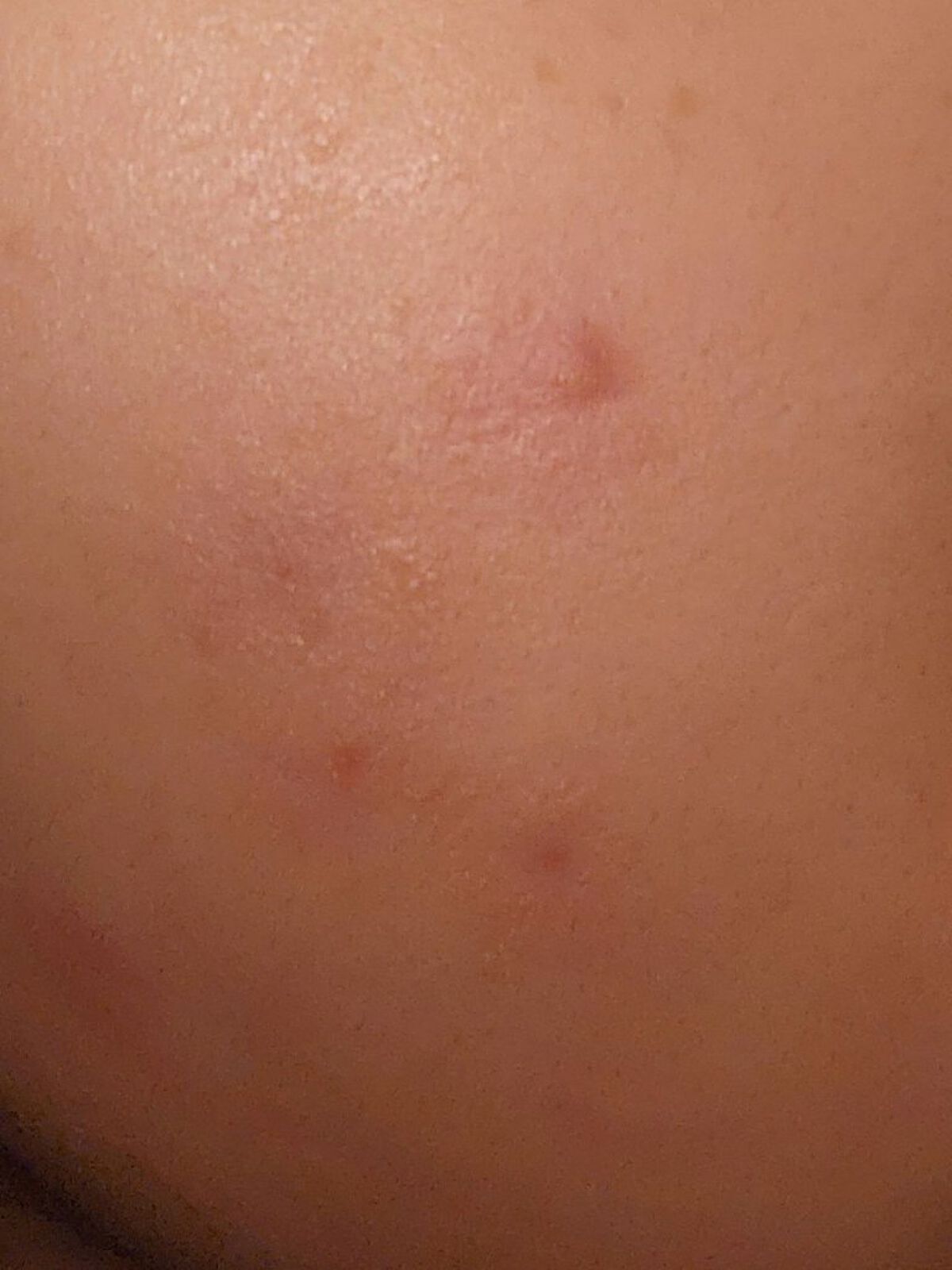 デュアック配合ゲル/医薬品/その他スキンケアを使ったクチコミ（2枚目）