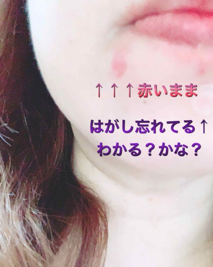 ゼロスポットパッチ/Today’s Cosme/にきびパッチを使ったクチコミ(3枚目)