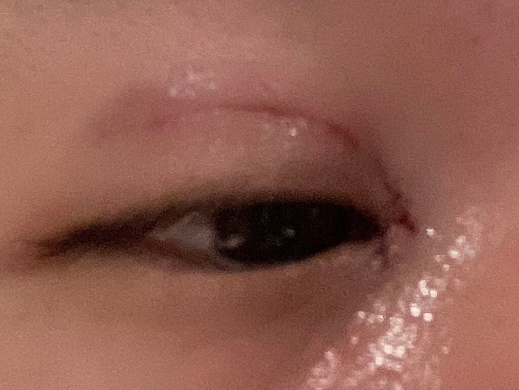 さくら。 on LIPS 「埋没法二回目、目頭切開の経過。術後夜。世のダウンタイム中の方一..」(2枚目)