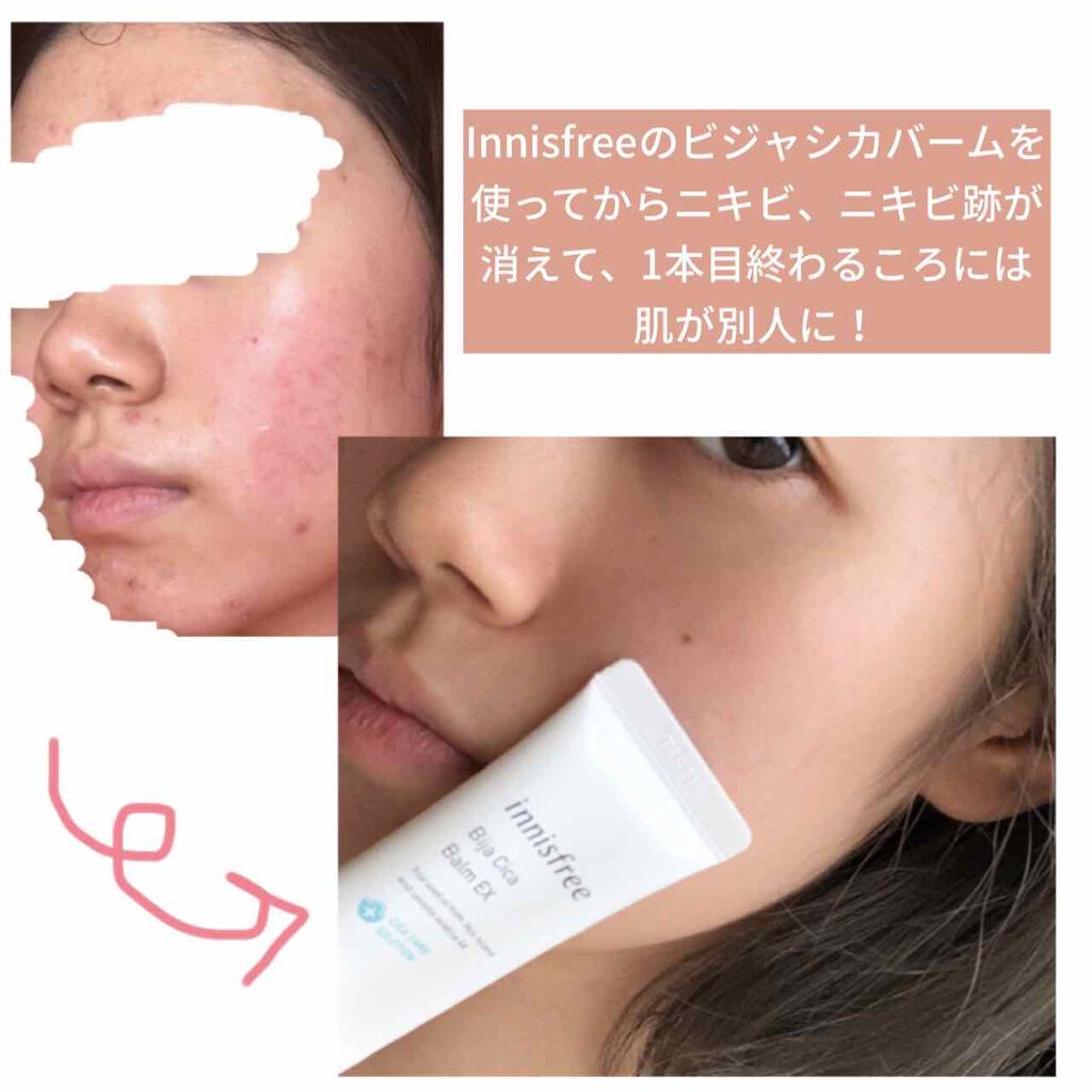 ビジャ シカバーム Ex Innisfreeの口コミ 汚肌写真注意 なにをしてもニビキ肌に By ぶりっこちゃん 乾燥肌 代前半 Lips ビジャ シカバーム Ex Innisfreeの口コミ 汚肌写真注意 なにをしてもニビキ肌に By ぶりっこちゃん 乾燥肌 代前半 Lips