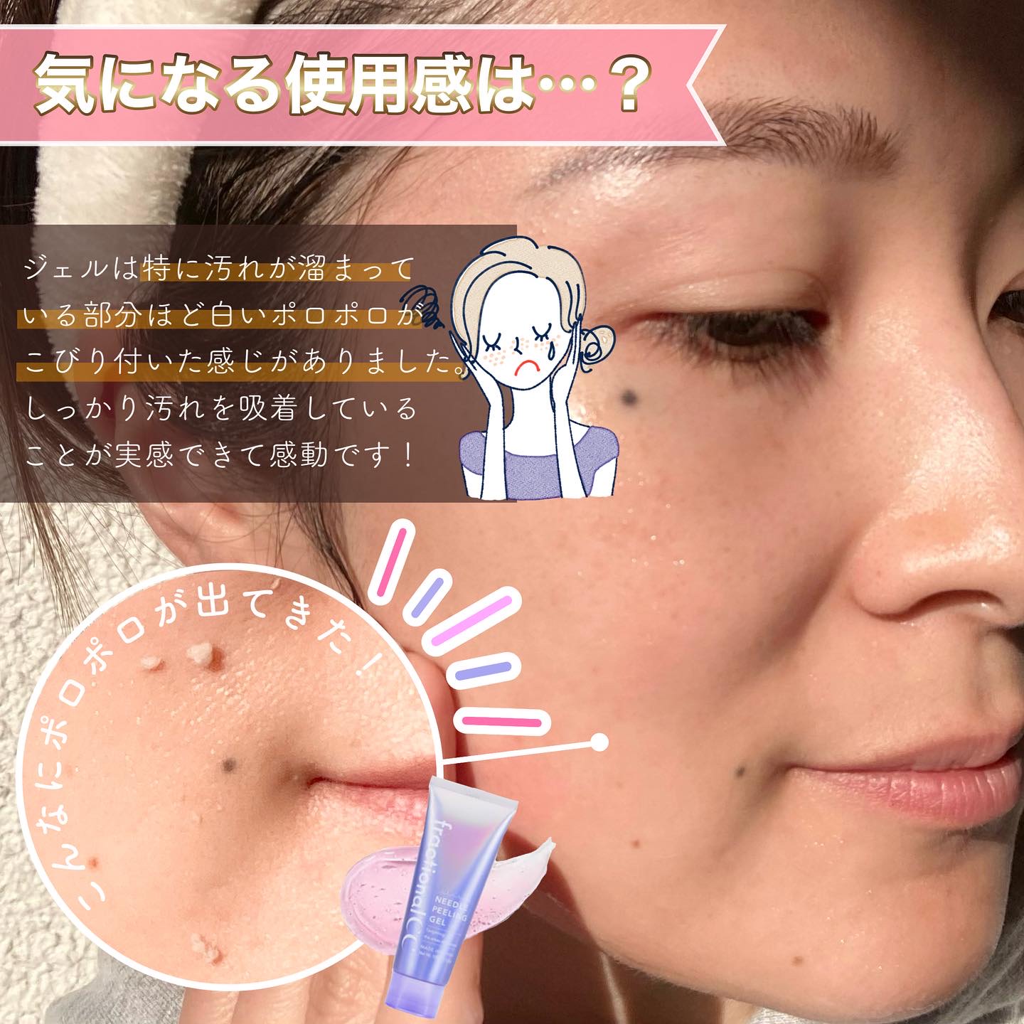 ニードルピーリング fractional CC 【公式】フラクショナルCC ニードルピーリングジェル