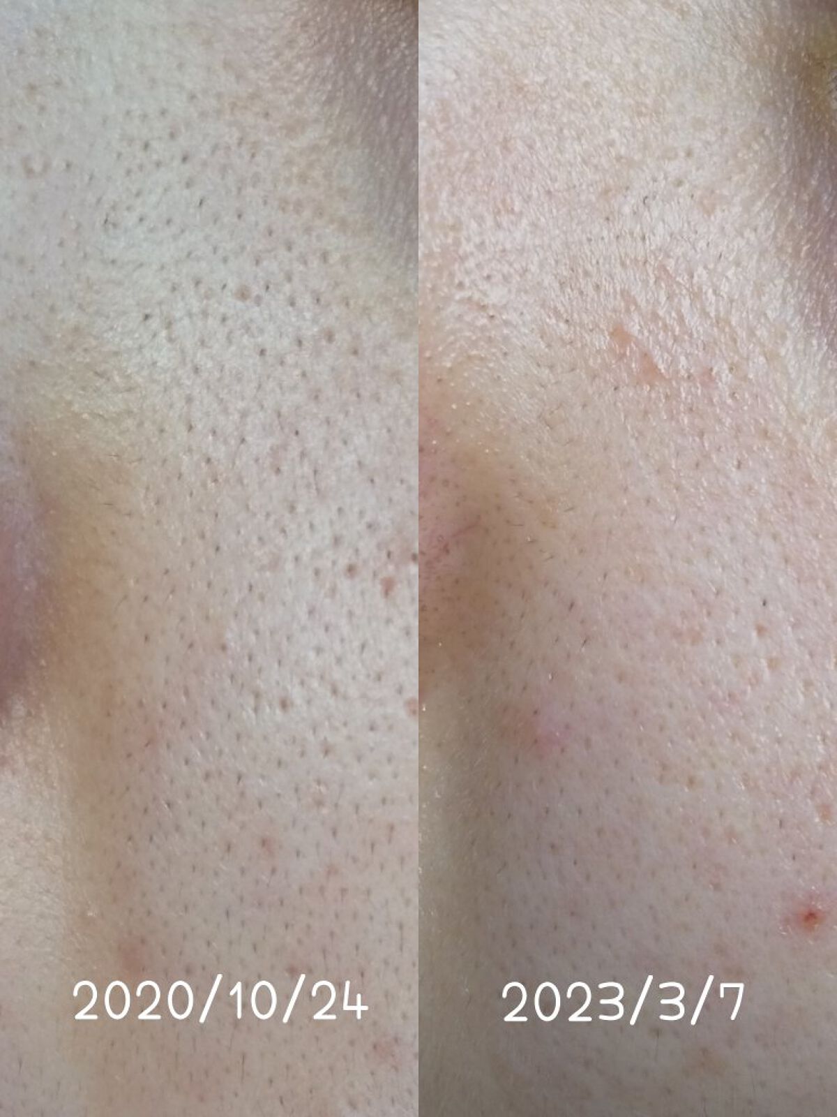 ウィッチヘーゼルエキス（ハマメリス葉エキス）/TUNEMAKERS/美容液を使ったクチコミ（3枚目）