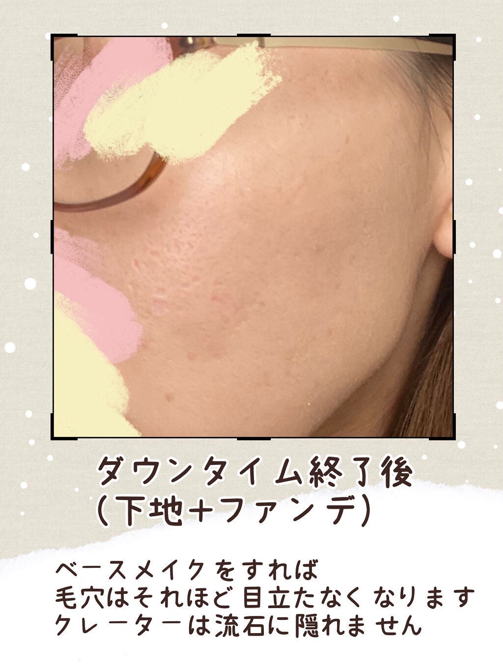 V on LIPS 「クレーター肌のダーマペン4備忘録📝中学生の時に顔一面のニキビに..」(7枚目)