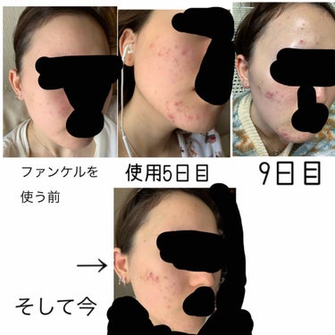 メラノCC 薬用 しみ 集中対策 美容液のクチコミ「現役ニキビを4ヶ月でなんとか撃退したので最終的にたどり着いたスキンケアのメモです✍

肌荒れで.....」（2枚目）