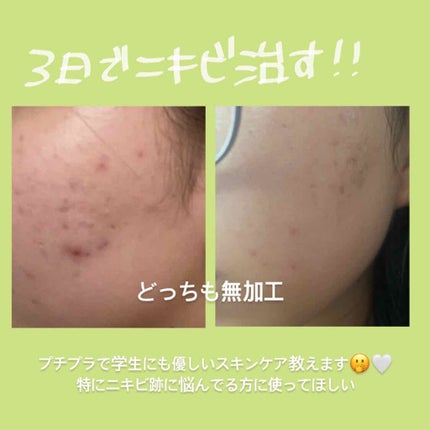 A アクネフォーム/NOV/洗顔フォームを使ったクチコミ(1枚目)