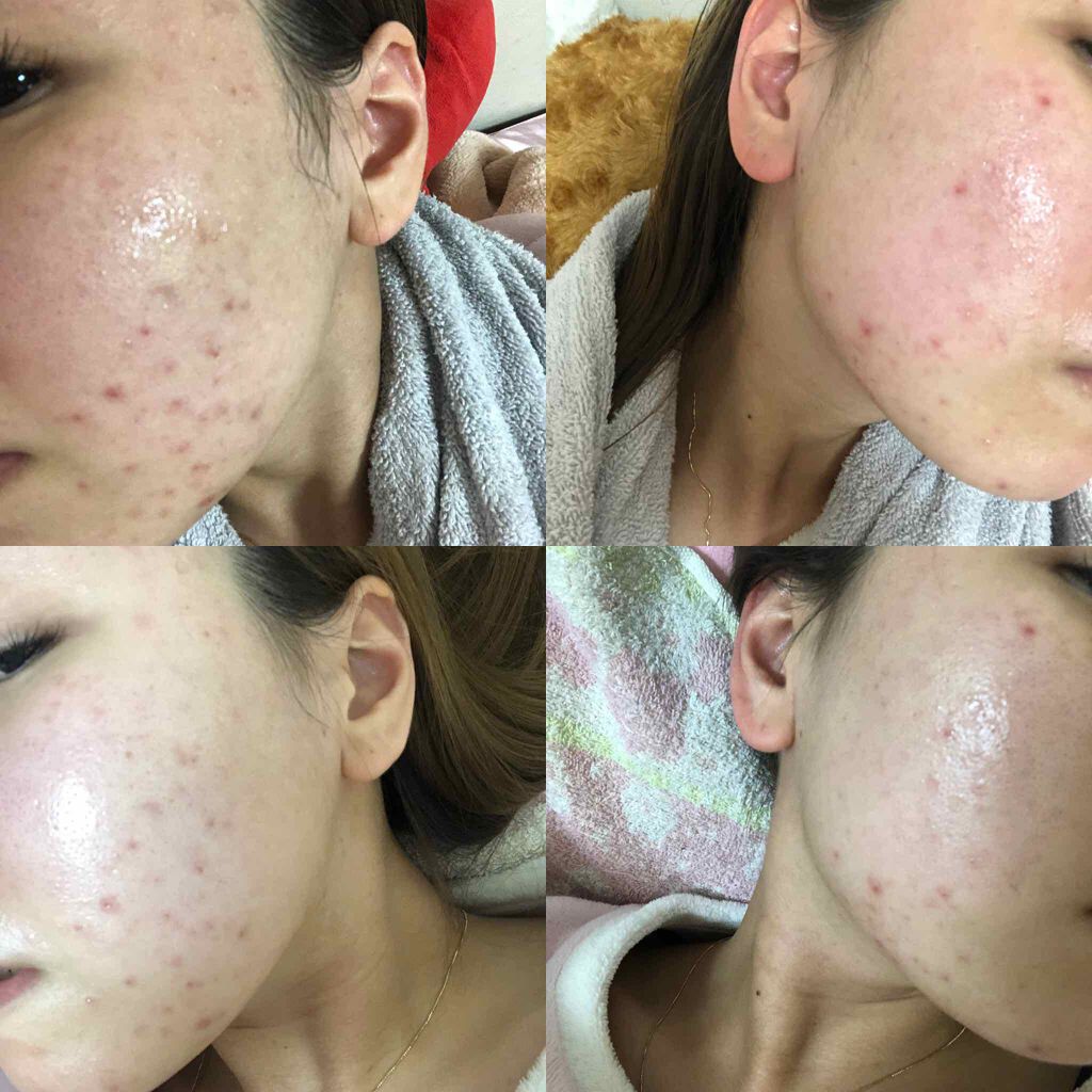 ディフェリンゲル0.1% /マルホ株式会社/その他を使ったクチコミ（2枚目）