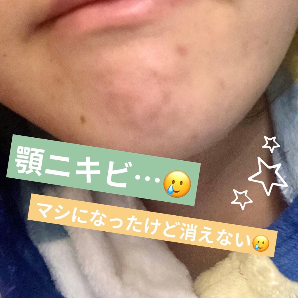 ペアアクネクリームW(医薬品)/ペア/その他を使ったクチコミ(2枚目)