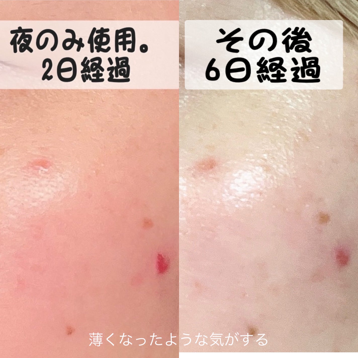 PDRNピンクアンプル PDRN 10,000ppm配合/MEDICUBE/美容液を使ったクチコミ(4枚目)