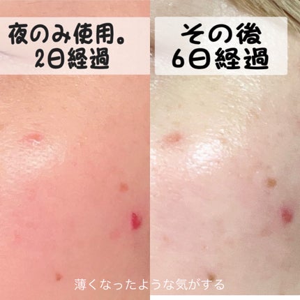 PDRNピンクアンプル PDRN 10,000ppm配合/MEDICUBE/美容液を使ったクチコミ(4枚目)