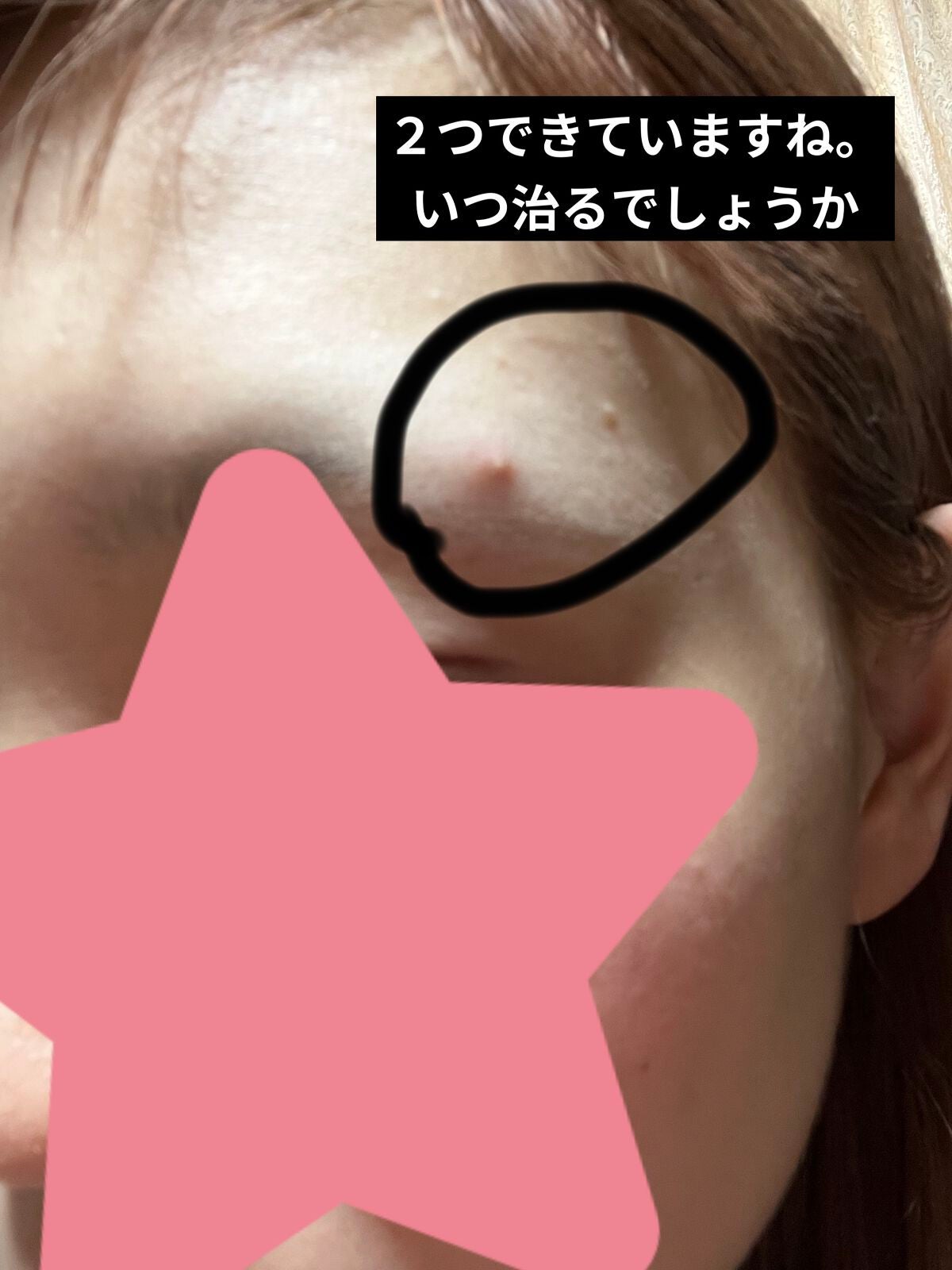 ニキビ治療薬(医薬品)/メンソレータム アクネス/その他を使ったクチコミ(2枚目)