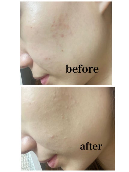 マスクフィットオールカバーデュアルコンシーラー/TIRTIR(ティルティル)/コンシーラーを使ったクチコミ(2枚目)