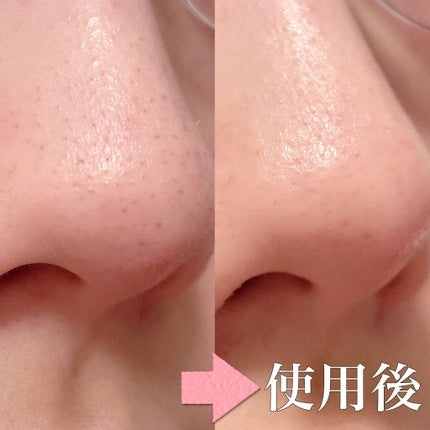 ブラックヘッドクリア2ステップノーズパッチ/DPU/シートマスク・パックを使ったクチコミ(7枚目)