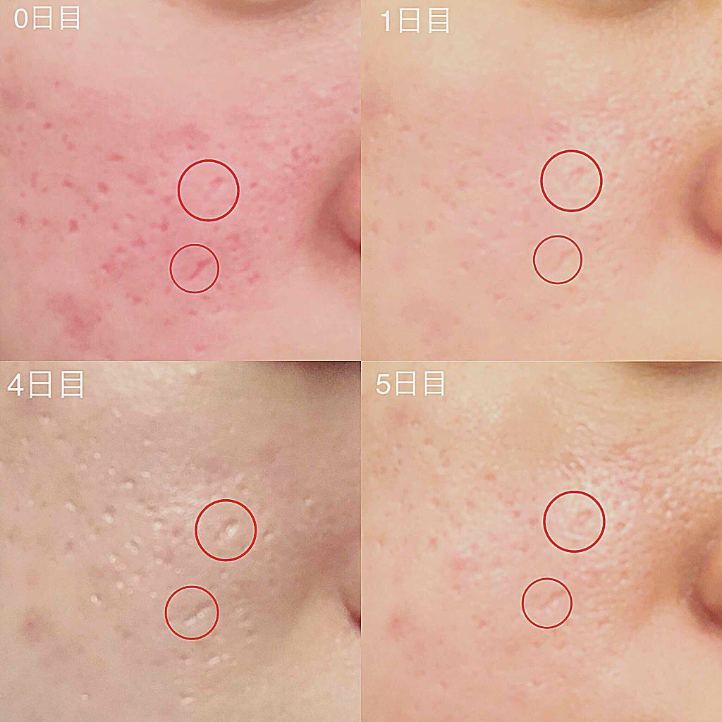 バイオイル/バイオイル/フェイスオイルを使ったクチコミ(3枚目)