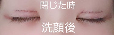 さや on LIPS 「ご覧頂きありがとうございます。ダウンタイム2日目と3日目です。..」（4枚目）