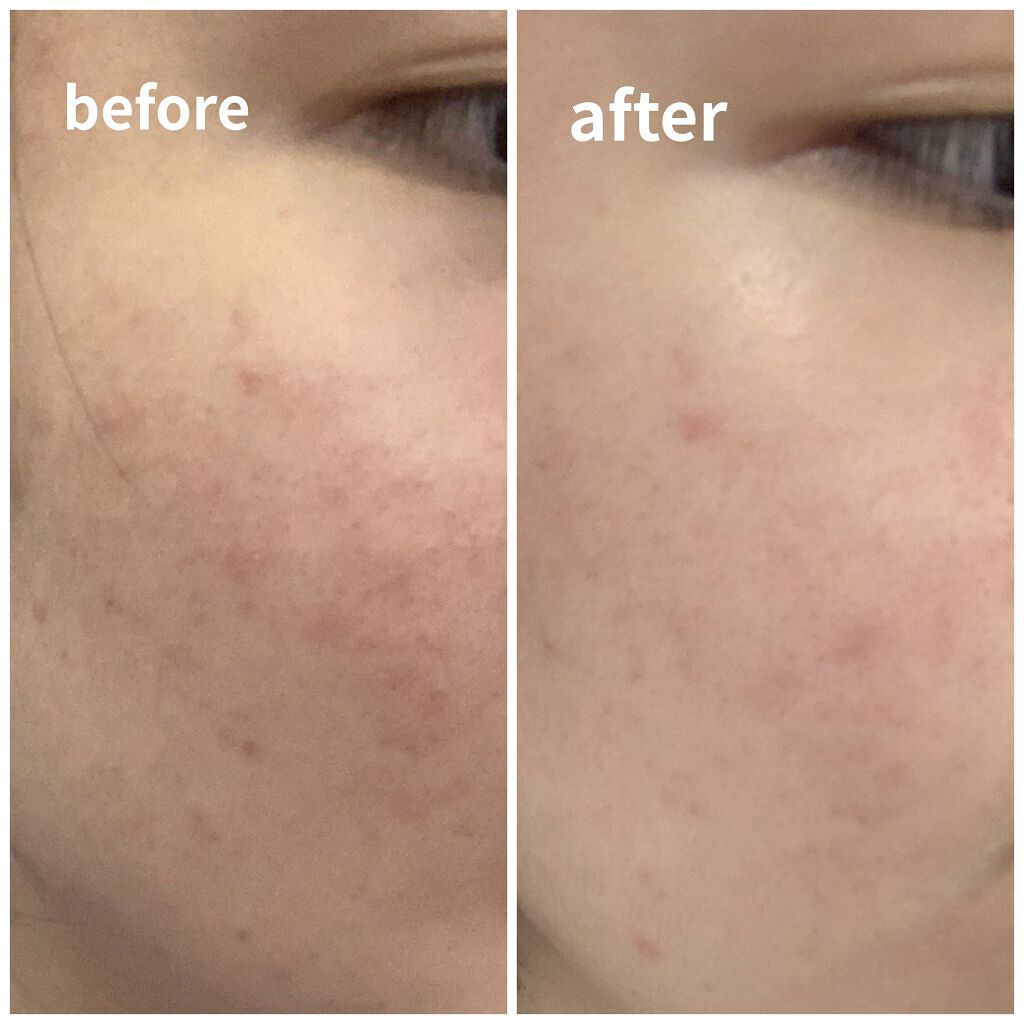 アクネキュアクリーム(医薬品)/IHADA/その他を使ったクチコミ（2枚目）