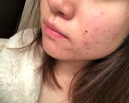 マンスリースキンケアプログラム(旧)/APEX/スキンケアキットを使ったクチコミ(4枚目)