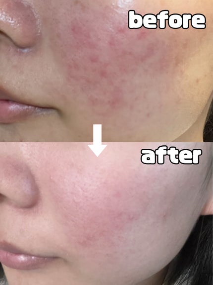 ドクダミ 77 スージングトナー/Anua/化粧水を使ったクチコミ(2枚目)