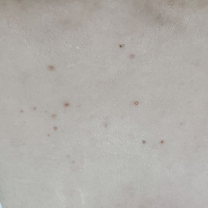 苺貴族 on LIPS 「血行促進・皮膚保湿剤ヘパリン類似物質ローション0.3%「日医工..」(4枚目)