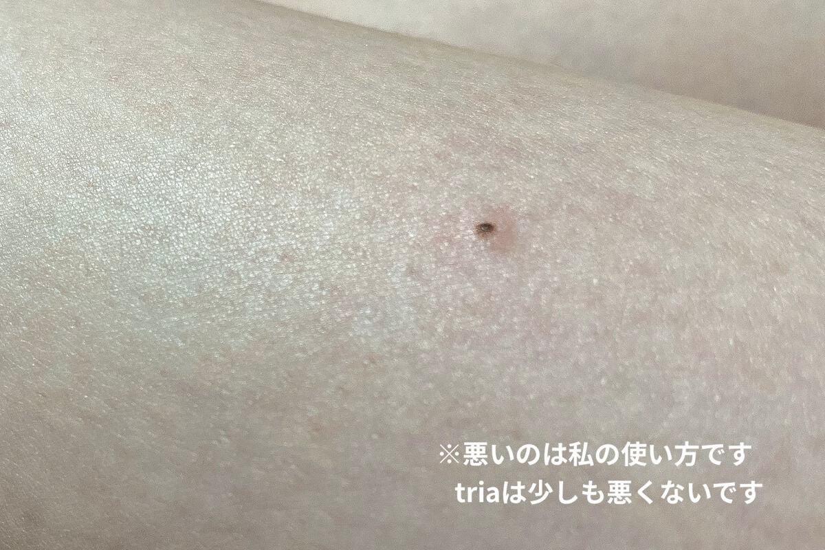 トリア・パーソナルレーザー脱毛器 4X/トリア/家庭用脱毛器を使ったクチコミ(5枚目)