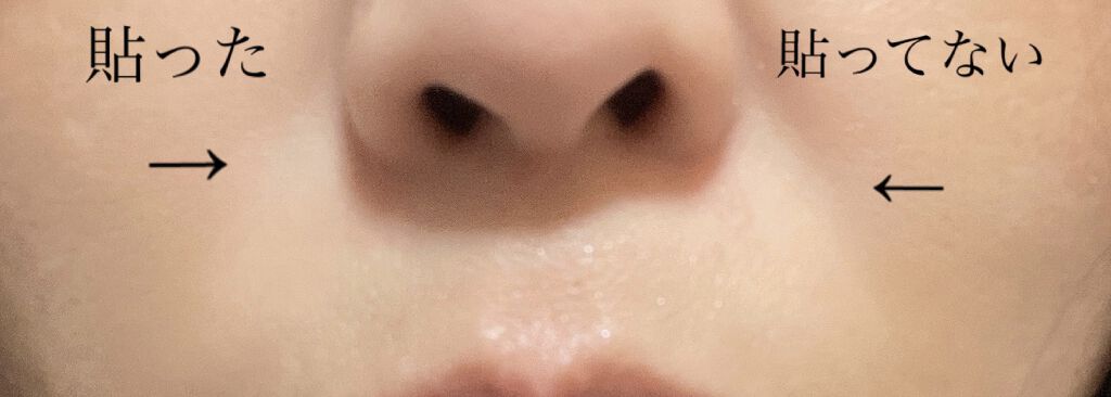 クリアターン ヒアロチューン マイクロパッチ 1500/クリアターン/シートマスク・パックを使ったクチコミ（2枚目）