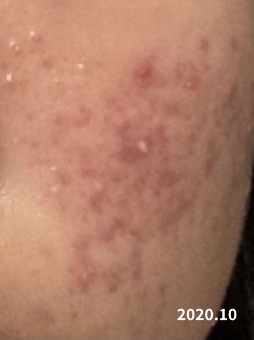 スキンピールバー ティートゥリー/サンソリット/洗顔石鹸を使ったクチコミ（2枚目）