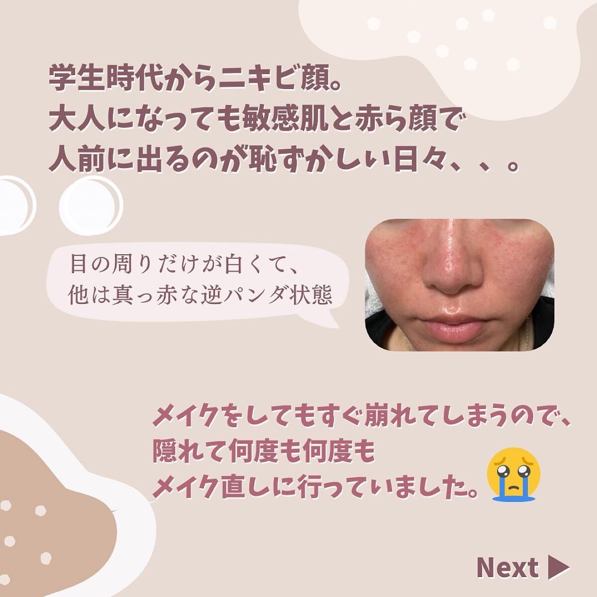 まゆめ on LIPS 「\🌟敏感肌がコンプレックスから脱却するまでにやったこと🌟/長年..」(3枚目)