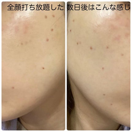 りっちゃん on LIPS 「やって良かった美容医療〜シミ治療編〜/わたしが今のところ1番..」(7枚目)