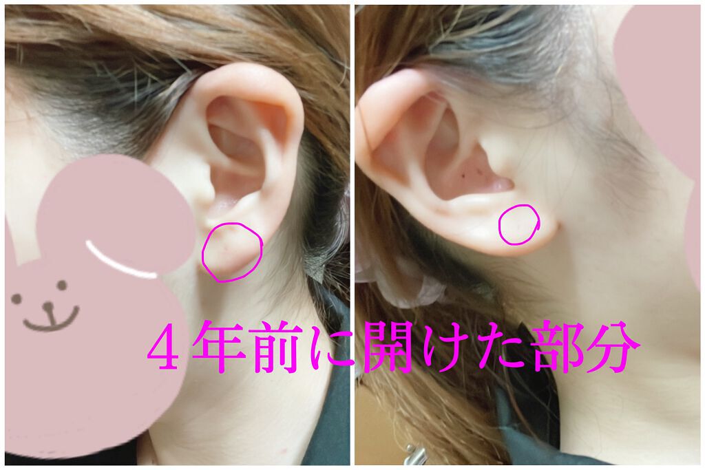 マキロンs （医薬品）/マキロン/その他を使ったクチコミ（3枚目）