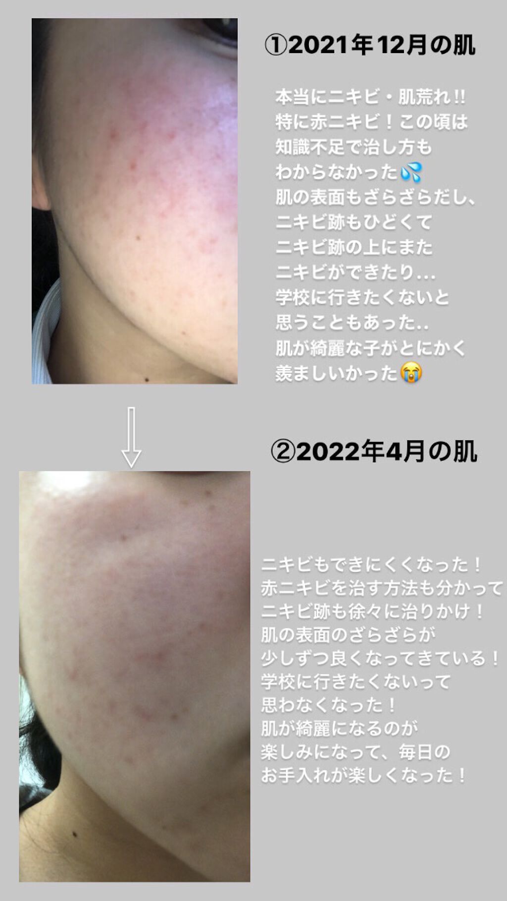 ノブ A アクネソープ/NOV/洗顔石鹸を使ったクチコミ(2枚目)