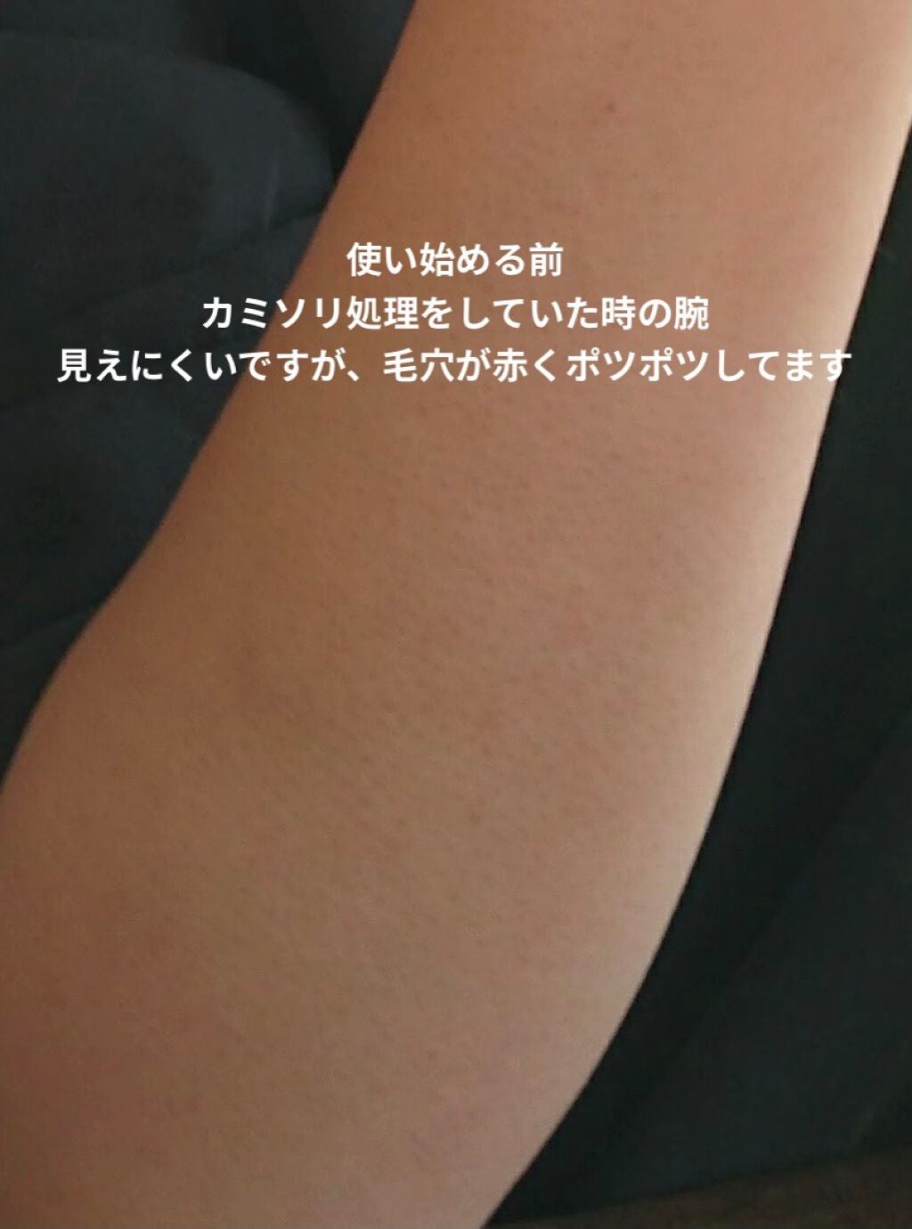 光美容器 光エステ <ボディ&フェイス用> ES-WP81/Panasonic/家庭用脱毛器を使ったクチコミ(3枚目)