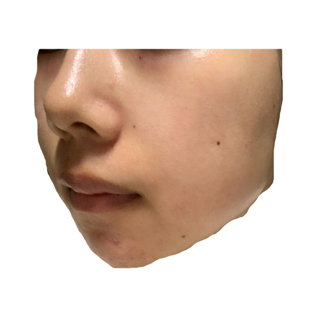 ベピオゲル/マルホ株式会社/その他を使ったクチコミ（1枚目）