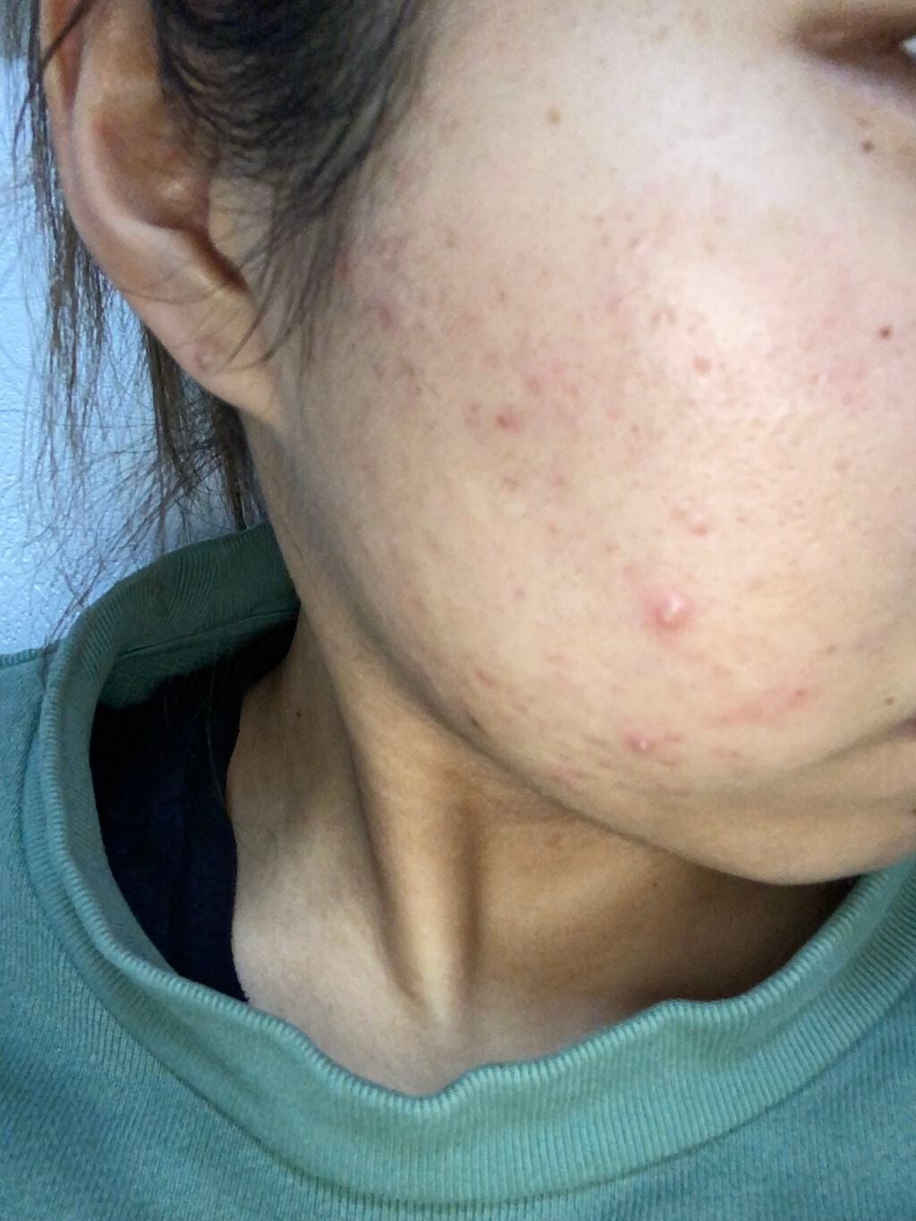 orange_blush_gxo on LIPS 「肌にはお水が大事😉少しずつちょっとずつ治していこう😉閲覧注意で..」(1枚目)