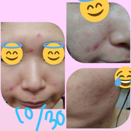 VCスターターセット/VCシリーズ/スキンケアキットを使ったクチコミ(4枚目)