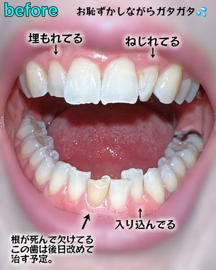 invisalign go/invisalign/その他を使ったクチコミ(3枚目)