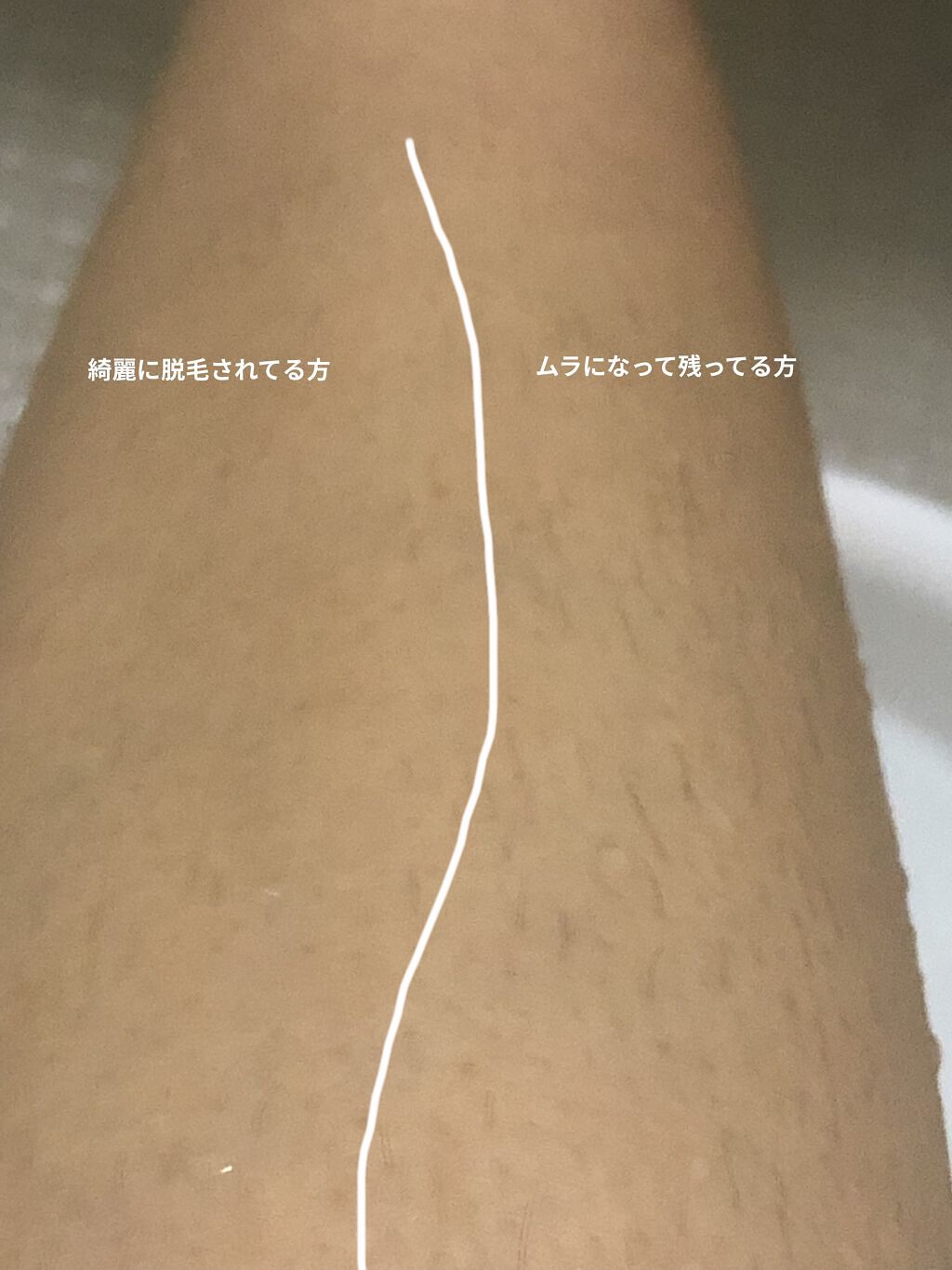 IPL光脱毛器/NiZmir/家庭用脱毛器を使ったクチコミ（3枚目）