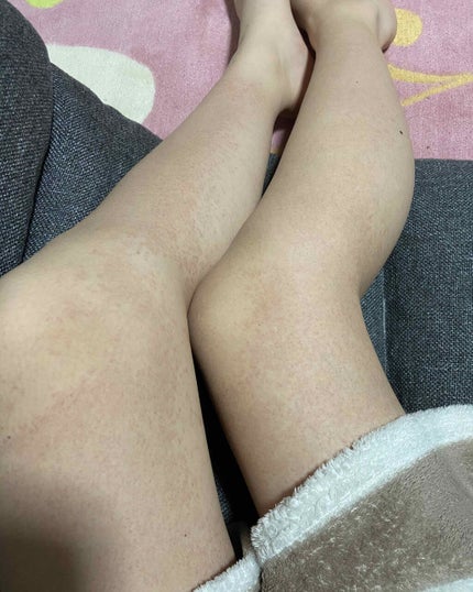 ブラウンシルクエキスパート (光美容器)/ブラウン/家庭用脱毛器を使ったクチコミ(2枚目)