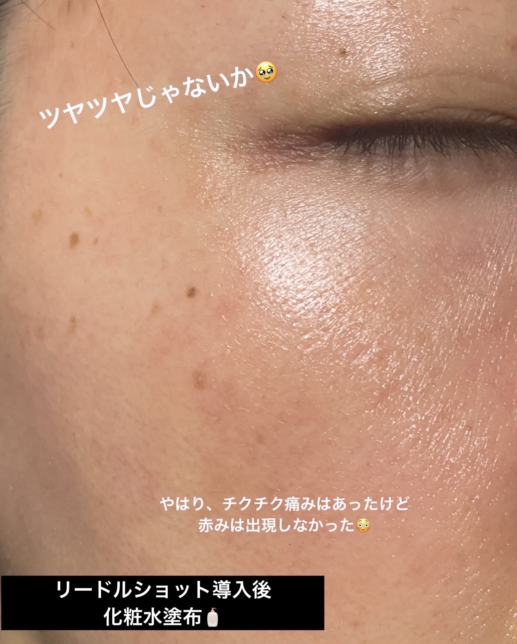 S300 リードル/VT/美容液を使ったクチコミ（3枚目）