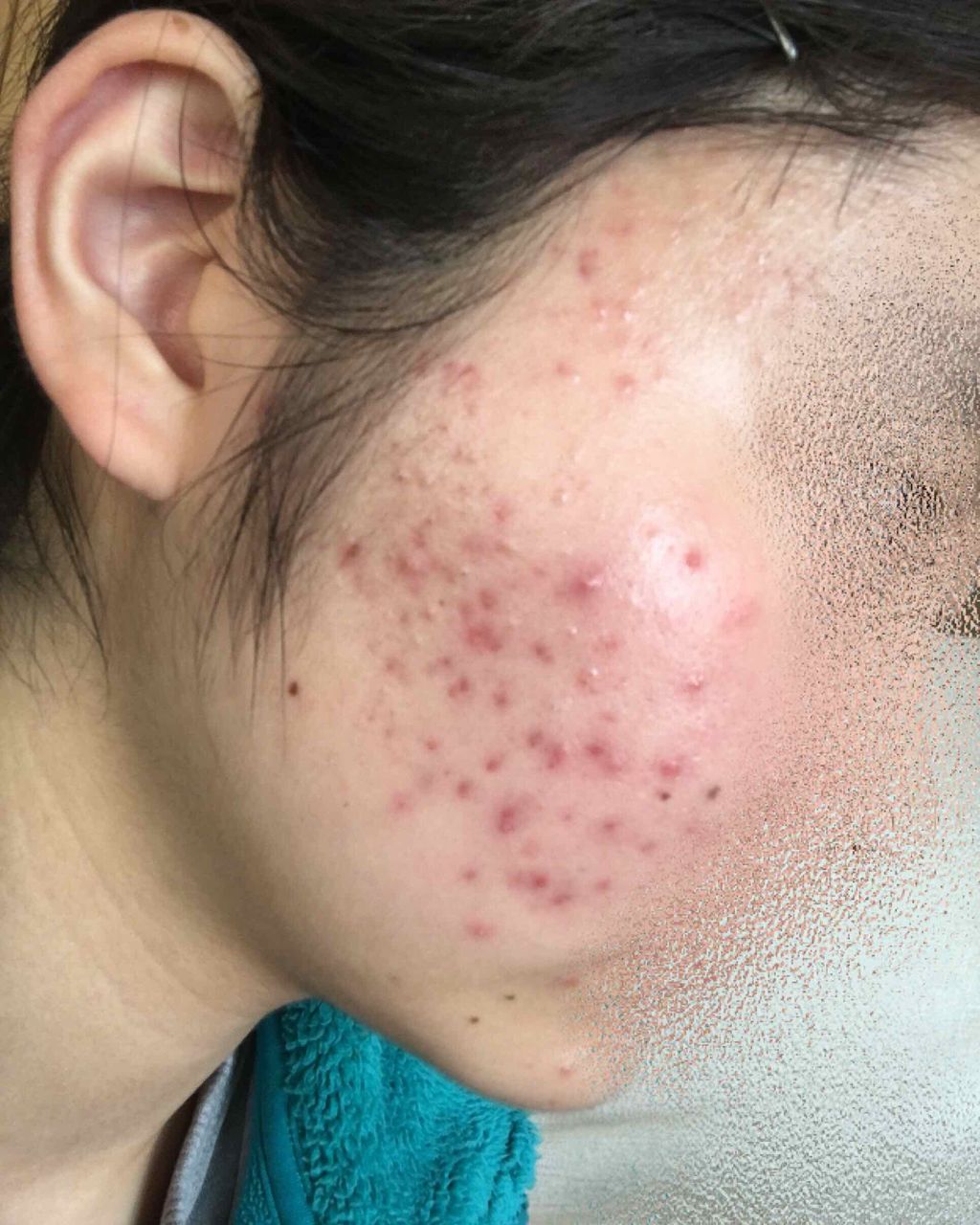 薬用 しみ 集中対策 美容液/メラノCC/美容液を使ったクチコミ（2枚目）