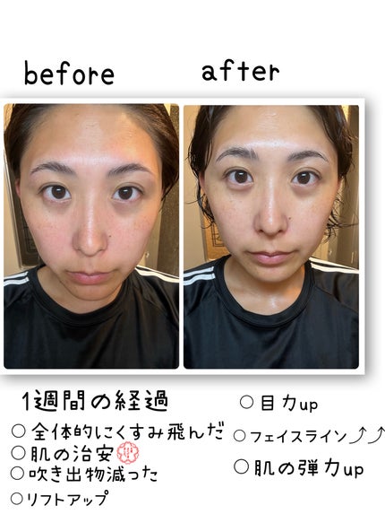 リマージ糸リフティングアンプル/REVENIP/美容液を使ったクチコミ(5枚目)