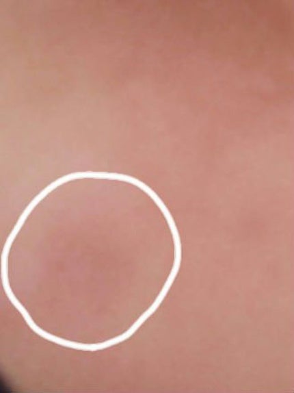 プロCICA クリアスポットパッチ/VT/その他スキンケアを使ったクチコミ(5枚目)