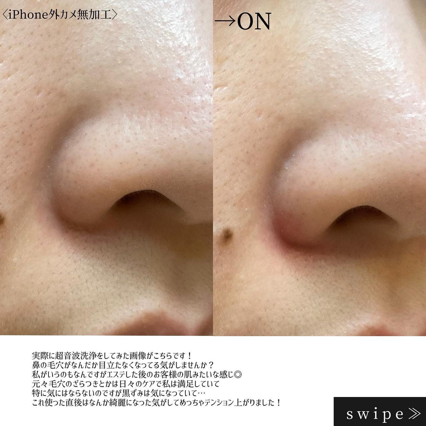 ウォーターピーリング/ANLAN/美顔器・マッサージを使ったクチコミ(6枚目)